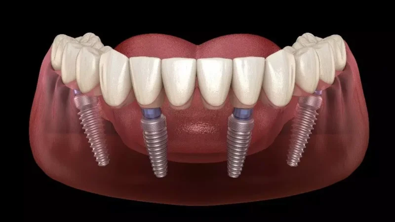 Can You Bite With Dental Implants?