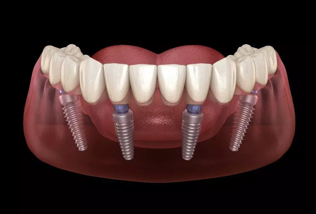 Can You Bite With Dental Implants?