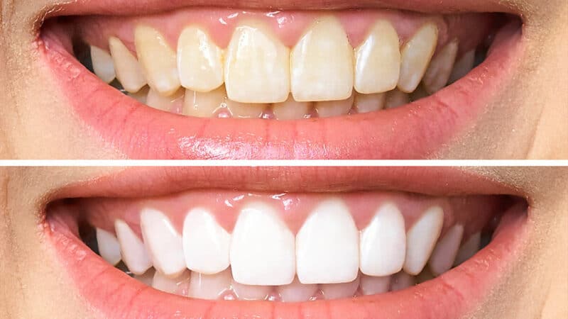 Importance of Professional Tooth Whitening
