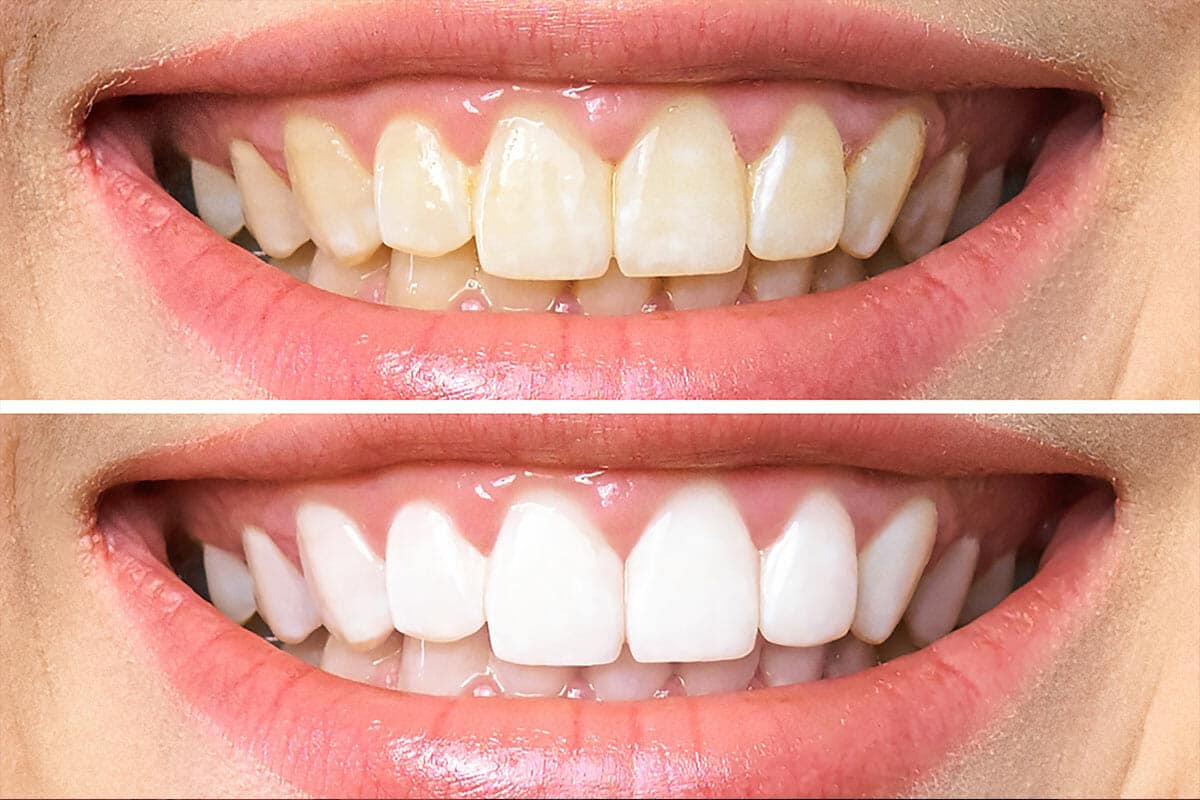 Importance of Professional Tooth Whitening