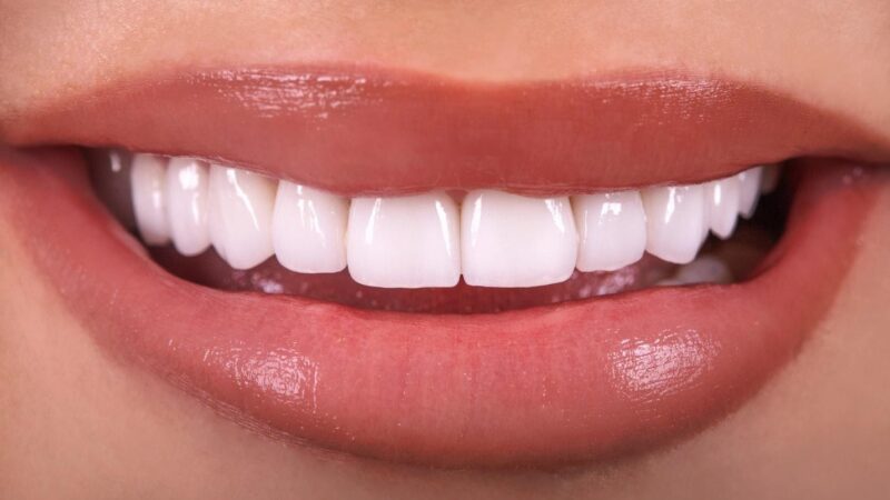 How To Choose The Best Veneers For Your Face Shape?