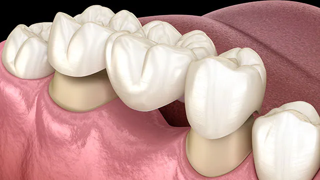 Dental Crowns That are Best for Front Teeth |  Requirement of Dental crown