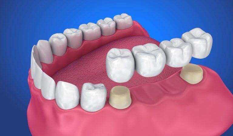 Everything You Need to Know About Dental Crowns and Bridges