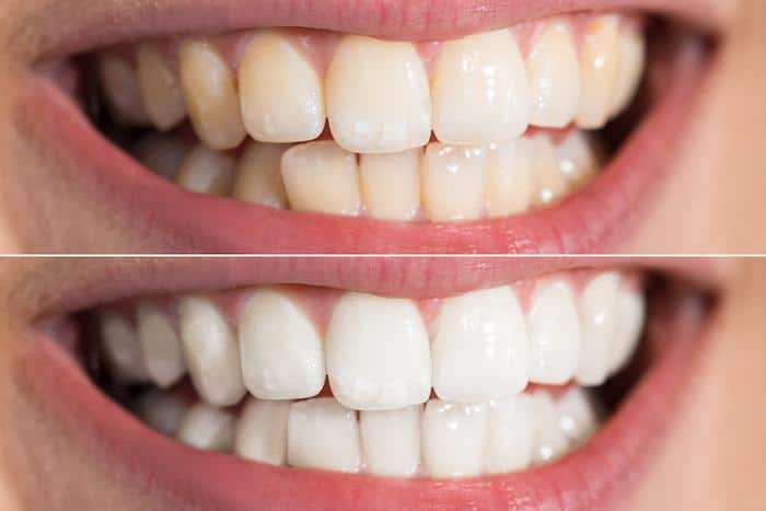 Reasons Why You Should Consider Teeth Whitening