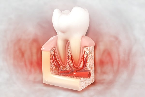 How long does it take for a root canal?