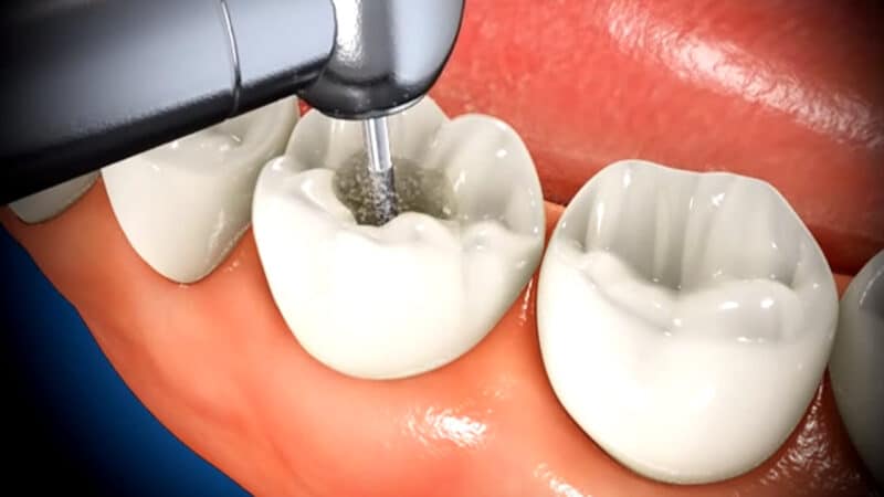 How long does it take to Recover from a Root Canal?