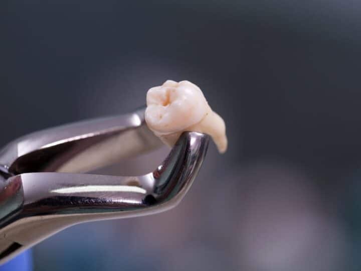 Tooth Extraction: Procedure, Aftercare & Recovery