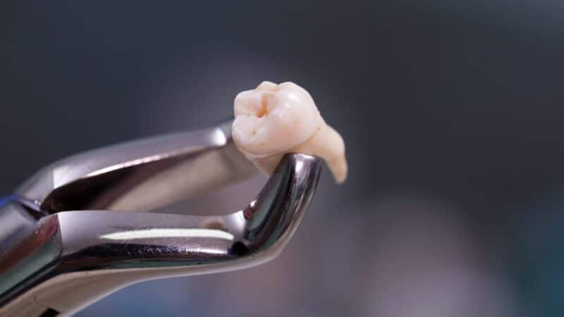 Tooth Extraction: Procedure, Aftercare & Recovery