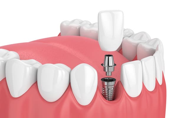 Do Dental Implants Hurt Afterwards?