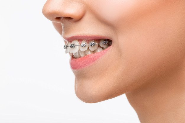 Can an Overbite be Fixed with Invisalign?