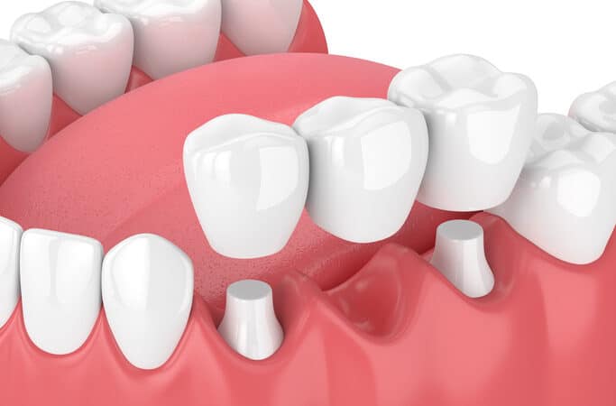 Can Tooth Sensitivity Increase After Getting a Crown?