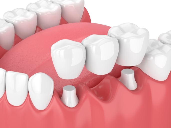 Can Tooth Sensitivity Increase After Getting a Crown?