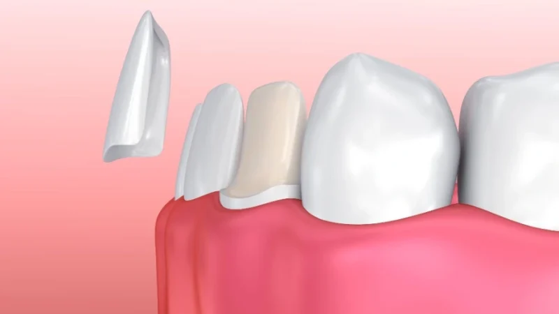 Do Porcelain Veneers Require Any Tooth Reduction?