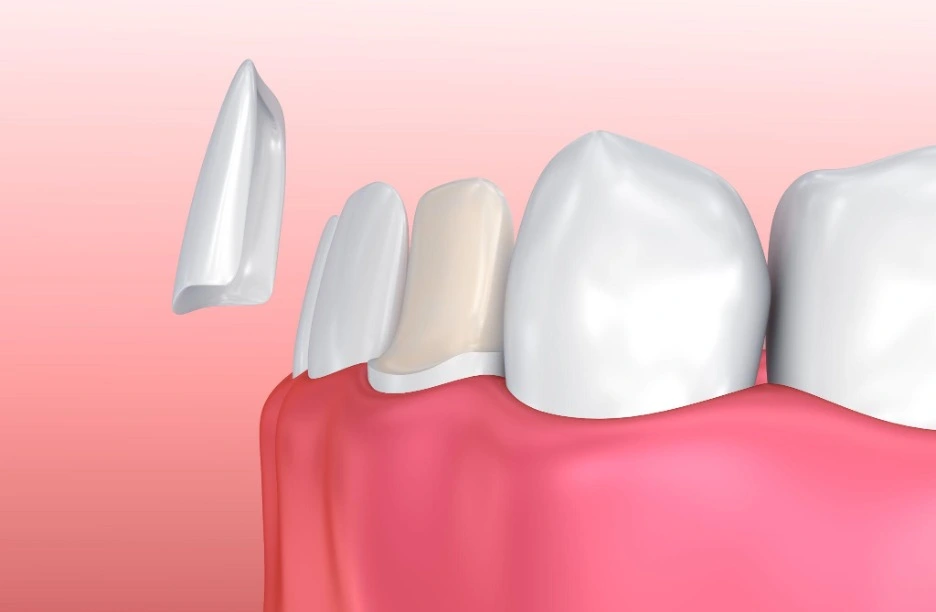Do Porcelain Veneers Require Any Tooth Reduction?