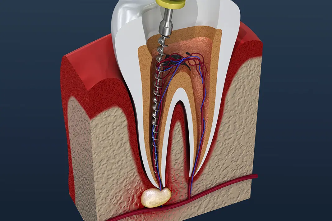 Is Pulp Regeneration the Future of Endodontic Treatments?